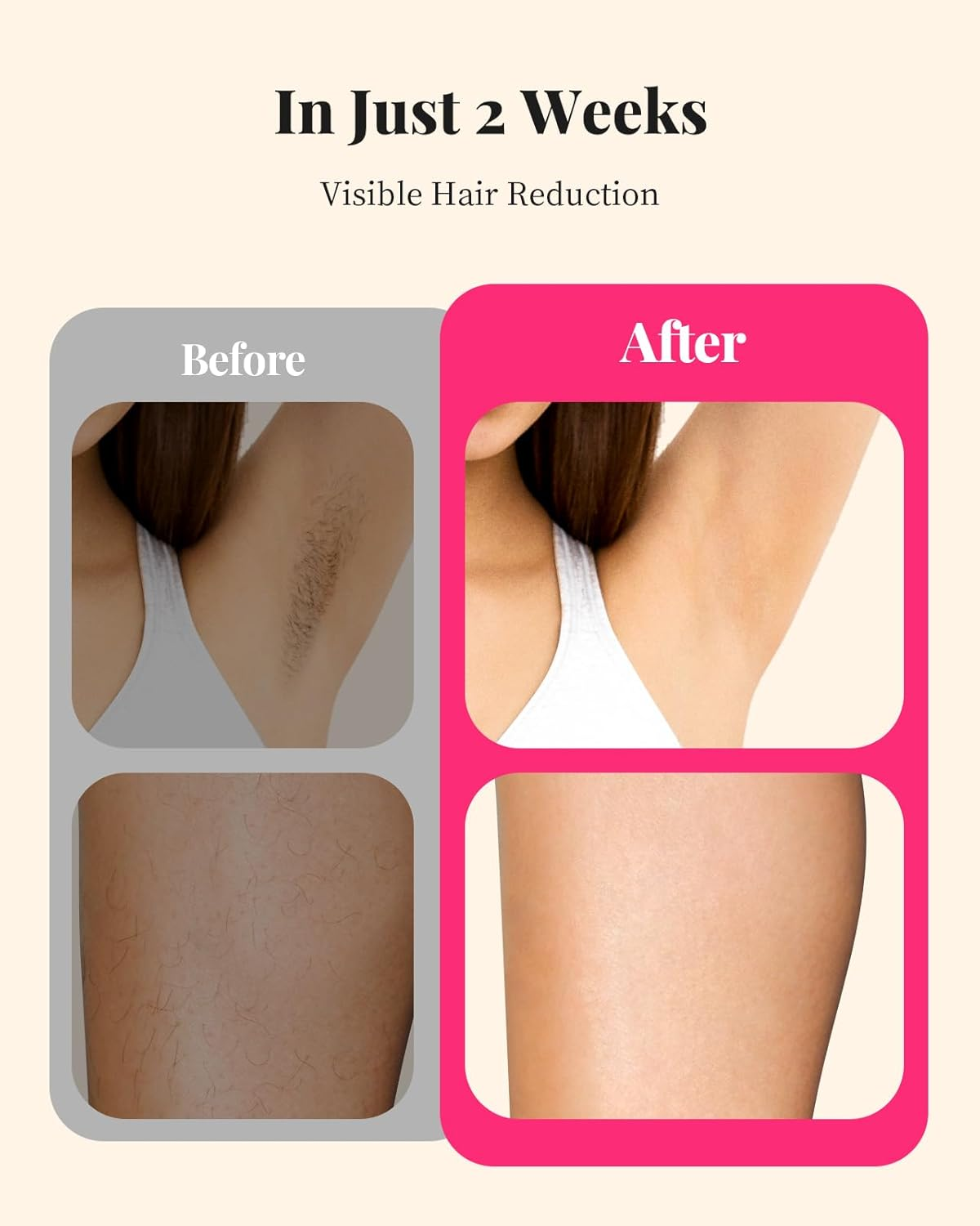 At-Home IPL Hair Removal Device